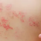 帯状疱疹
